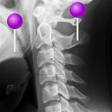Spine radiography with pins