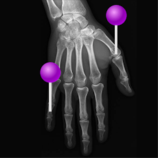 upper extremity x-rays with pins