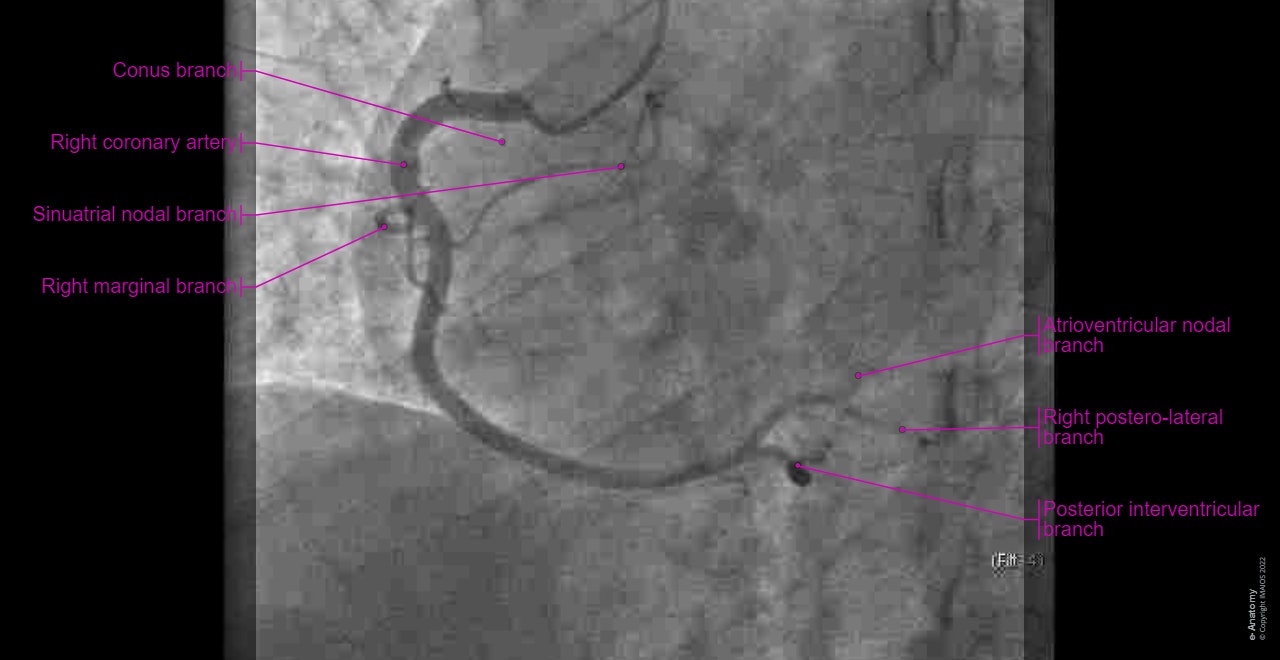 Anatomy of the coronary arteries on a coronary angiography : Right coronary artery