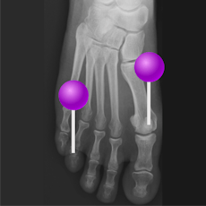 Lower limb Radiographs with pins