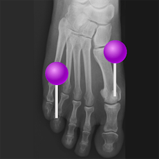 Lower limb Radiographs with pins