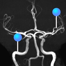 Arteries of brain MRI with pins