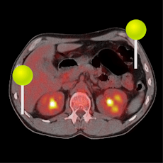 Cervix Thorax Abdomen Becken PET-CT mit Stiften