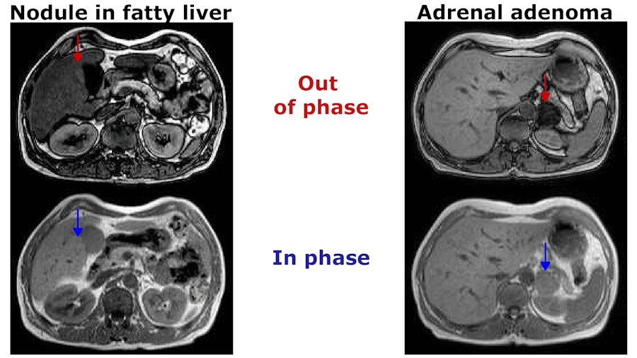 nodule in fatty liver and adrenal adenoma
