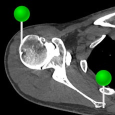 Shoulder CT arthrogram with green pins