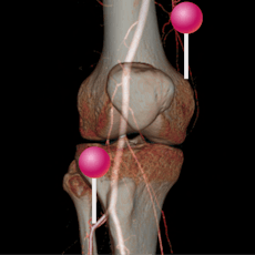 Leg: arteries-bones 3D with pins
