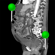 Abdominopelvic cavity with pins