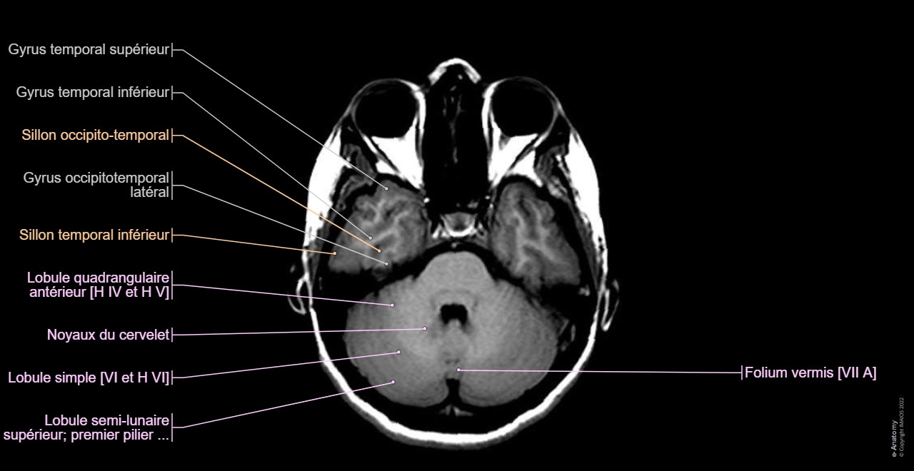 Cerveau - IRM en coupes axiales : anatomie normale | e-Anatomy