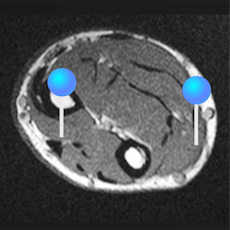 upper extremity MRI with pins