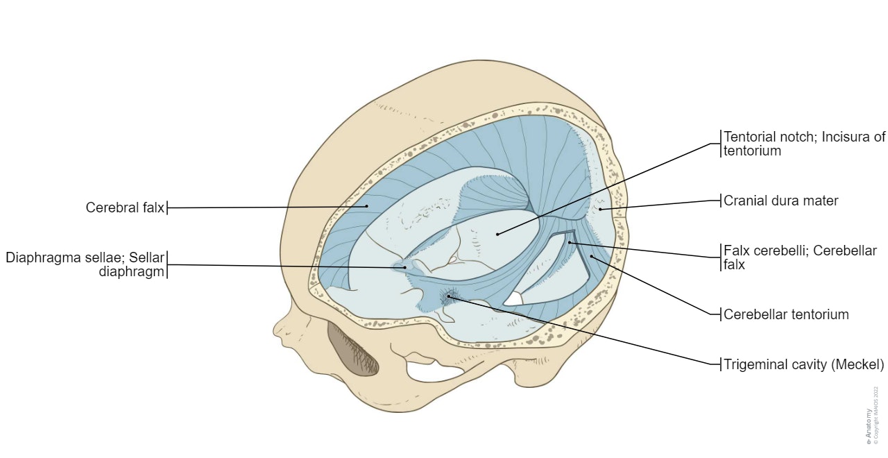 Meninges - Cranial dura mater : Gross anatomy - Illustrations: A. Micheau - MD : Cranial dura mater,  Cerebral falx,  Cerebellar tentorium,  Tentorial notch; Incisura of tentorium,  Falx cerebelli; Cerebellar falx,  Diaphragma sellae; Sellar diaphragm,  Trigeminal cavity, Pachymeninx; Dura mater