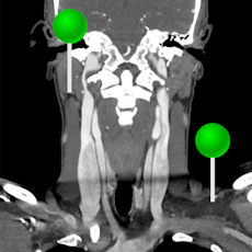 Head and neck CT with pins