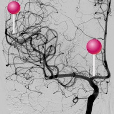 arteries of brain angiography with pins