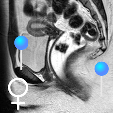 Pelvis féminin IRM avec épingles