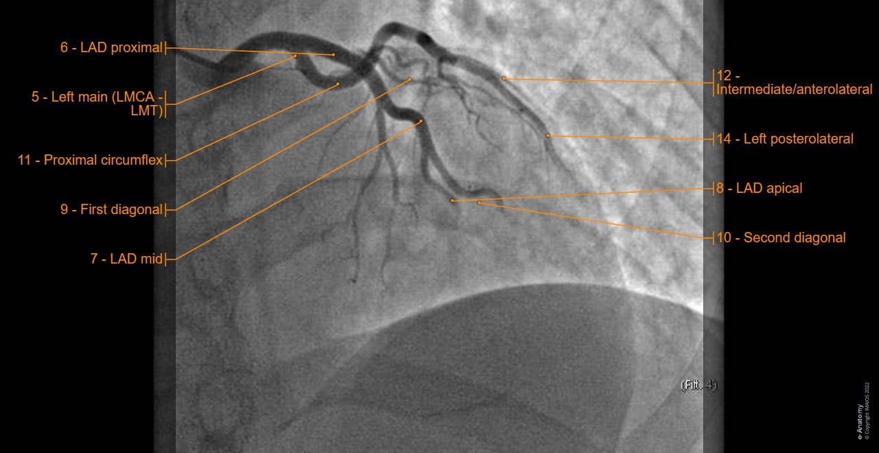 Left coronary artery : Left anterior descending artery (LAD) - Left circumflex artery (LCx)