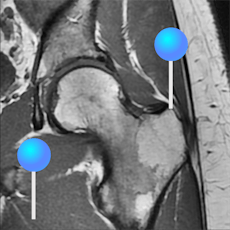 Hip MRI with pins