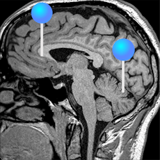 Gehirn 3D-MRT mit Stiften