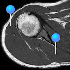 Shoulder MRI with pins