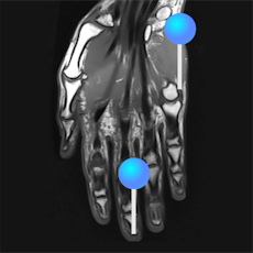 IRM de la main avec épingles