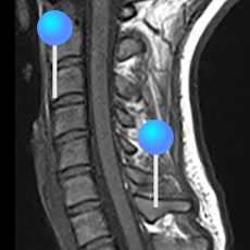 頚椎 MRI  ピン付き
