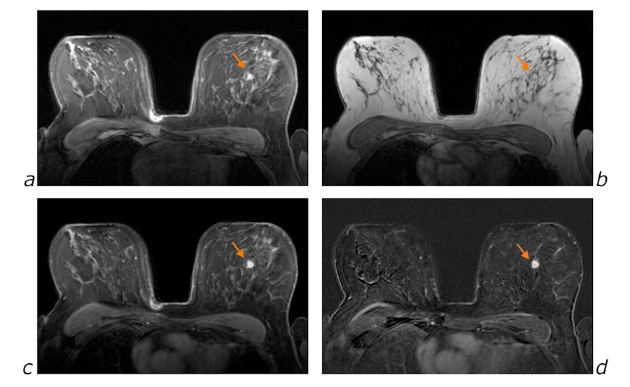 Fat signal suppression and enhancement after Gadolinium injection in breast MRI