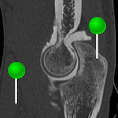 Elbow CT arthrography with pins