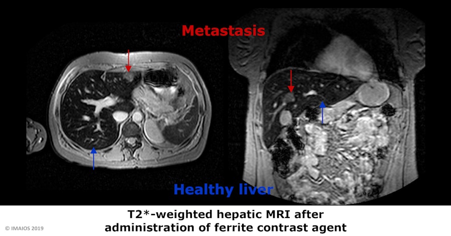 T2*-weighted hepatic MRI