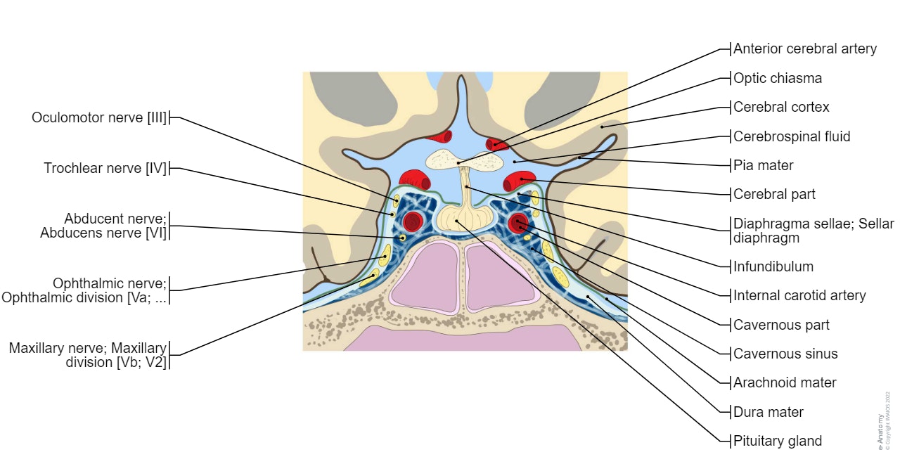 Cavernous sinus - Coronal section : Chiasmatic cistern, Pituitary gland, Optic chiasma, Internal carotid artery, Cavernous part, Oculomotor nerve [III], Trochlear nerve [IV], Ophthalmic nerve; Ophthalmic division [Va; V1], Maxillary nerve; Maxillary division [Vb; V2], Abducent nerve; Abducens nerve [VI]
