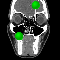 Face CT with pins
