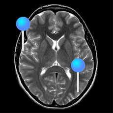 Brain MRI with pins