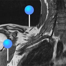 Brachial plexus MRI with pins