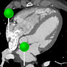 Coronary CT with pins