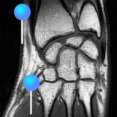 Wrist 3T MRI with pins