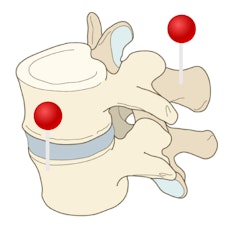 spine diagram with pins