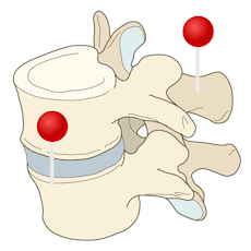 spine diagram with pins