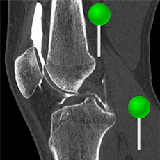Knie Arthro-CT mit Stiften