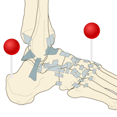 Lower extremity Illustrations with pins