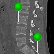 lumbar spine ct with pins