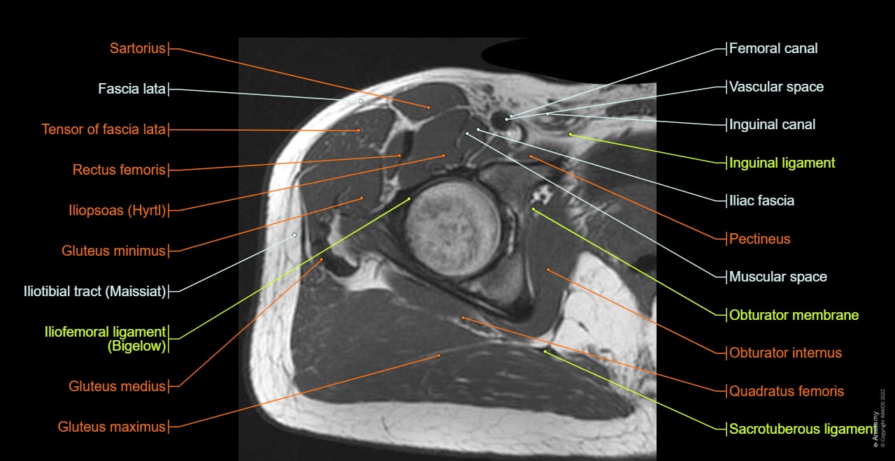 Cross sectional anatomy of the hip : axial slice of MRI with all anatomical structures labeled.