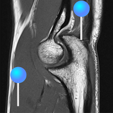 Elbow MRI with pins