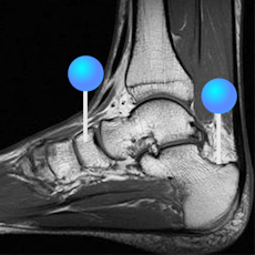 足関節 - 足部 MRI ピン付き