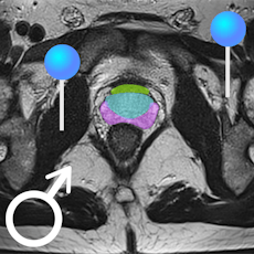 Pelvis masculin IRM avec épingles