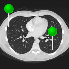 Thorax (CT) with pins