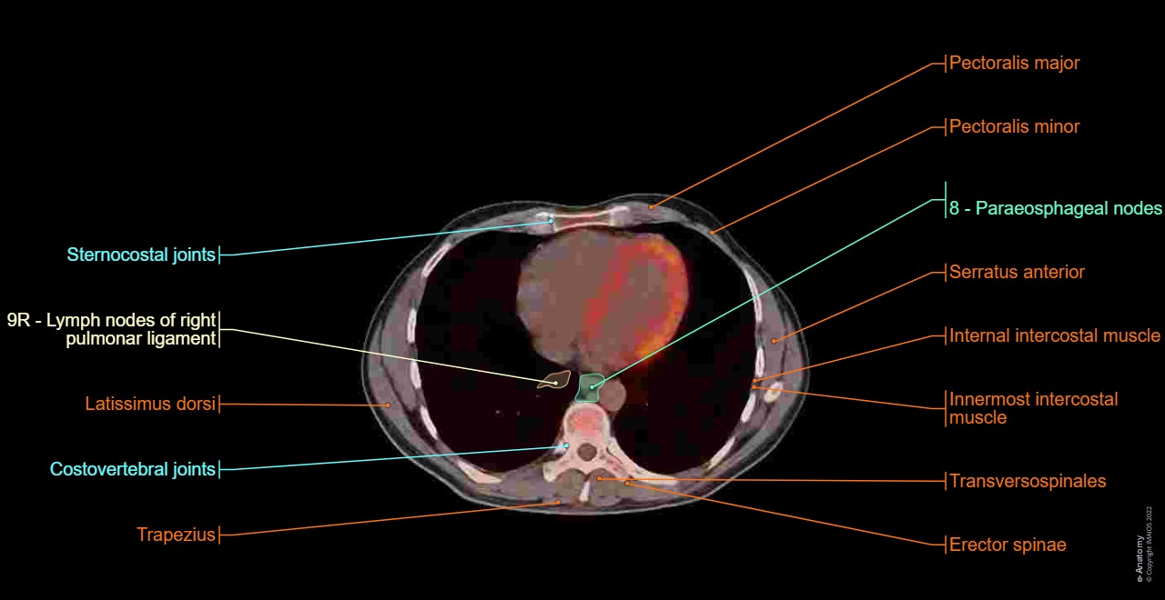 Positron emission Tomography - Computed tomography: IASLC - Lymph node stations