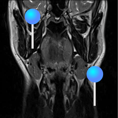 Face and neck MRI with pins