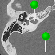 Petrous bone CT with pins