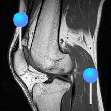 IRM du genou avec épingles
